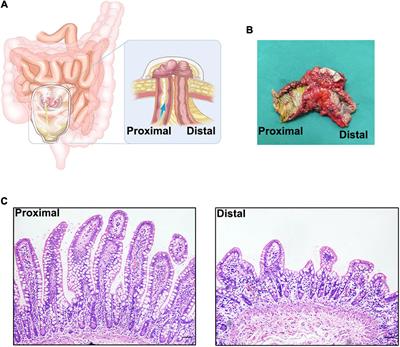 The Pathology and Physiology of Ileostomy